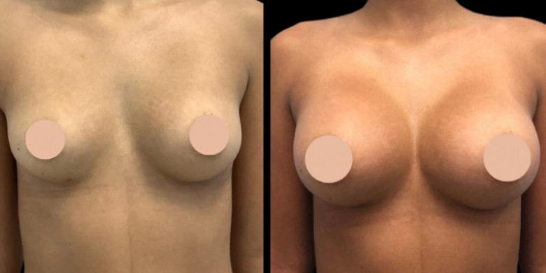 Best Time to Get Breast Augmentation Surgery in Dubai