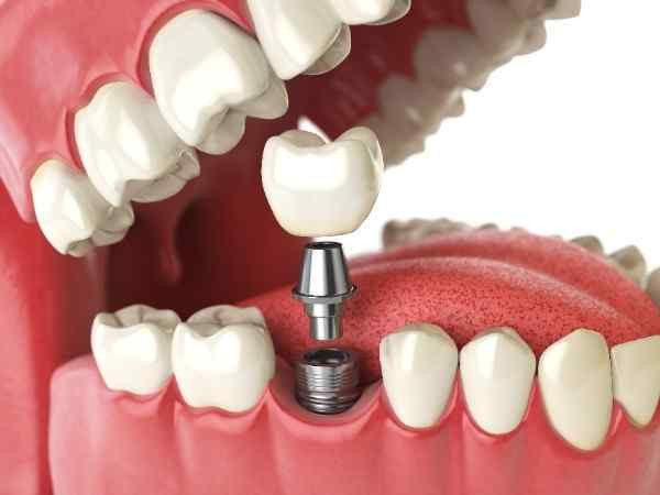  dental implants Bexhill 
