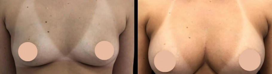 Breast Augmentation Surgeon