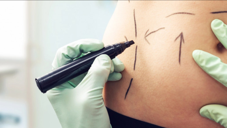 Find the Best Liposuction Surgeon in Dubai A Complete Guide
