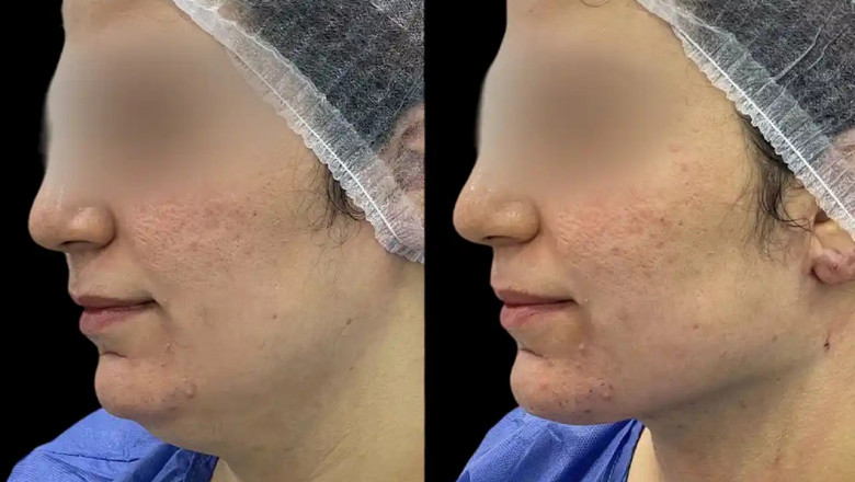 How Chin Fillers Can Help with Double Chin Reduction: The Best Plastic Surgeon in dubai Explains