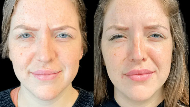 How the Best Plastic Surgeon in dubai Personalizes Botox for Different Skin Types