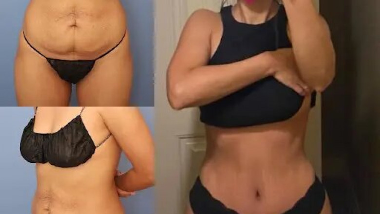 The Top Benefits of Choosing the Best Tummy Tuck Surgeon in dubai