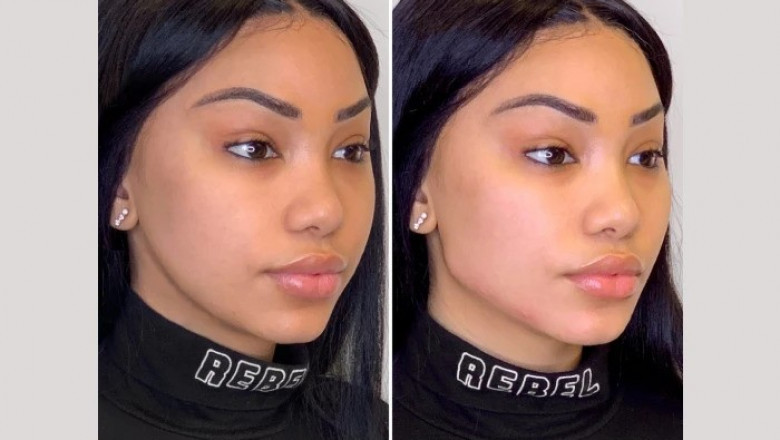 Thread Lift vs Facelift The Best Plastic Surgeon in Dubai Shares the Difference
