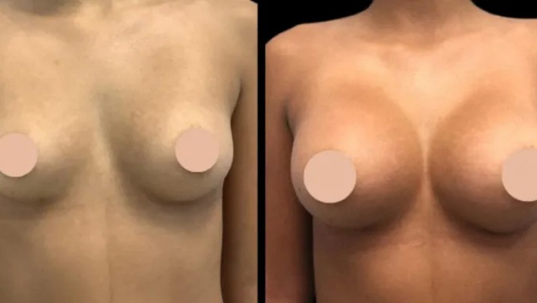 What to Expect Before, During, and After Breast Augmentation with the Best Breast Augmentation Surgeon in Dubai