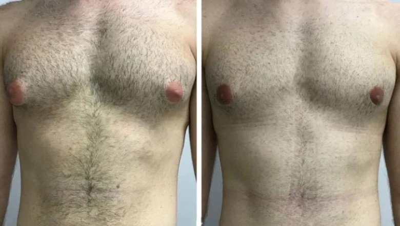 What to Expect from the Best Gynecomastia Surgeon in Dubai
