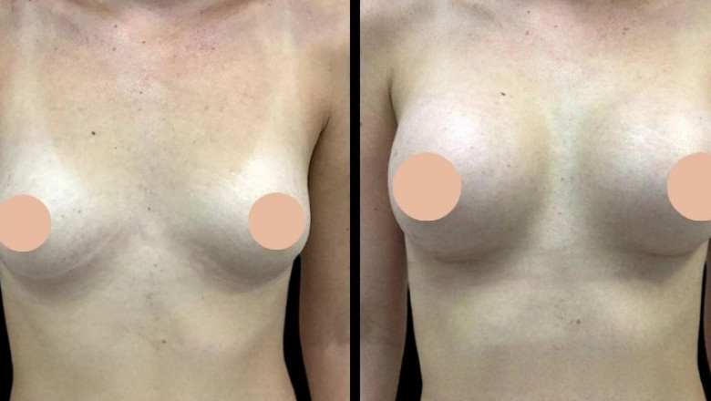 Why Choosing the Best Doctors in Dubai for Breast Augmentation is Gaining Popularity Among International Patients