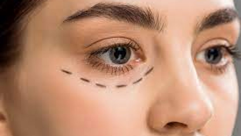 Understanding the Benefits of Eyelid Bag Surgery Dubai