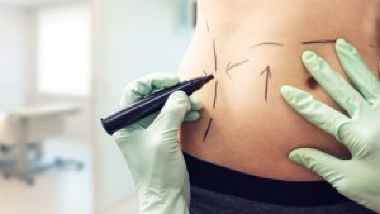 Tummy Tuck in Dubai for Men: Yes, It's a Growing Trend!