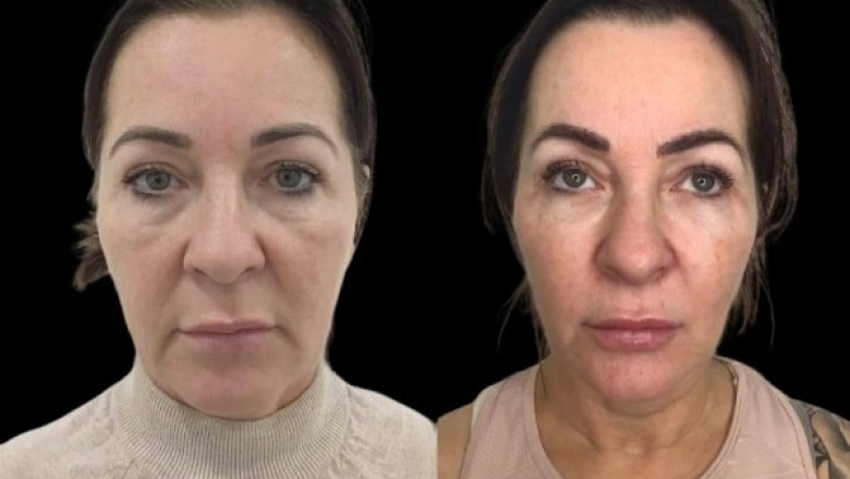 Curate Skin Brilliance through Profhilo and Best Aesthetic Clinic in dubai