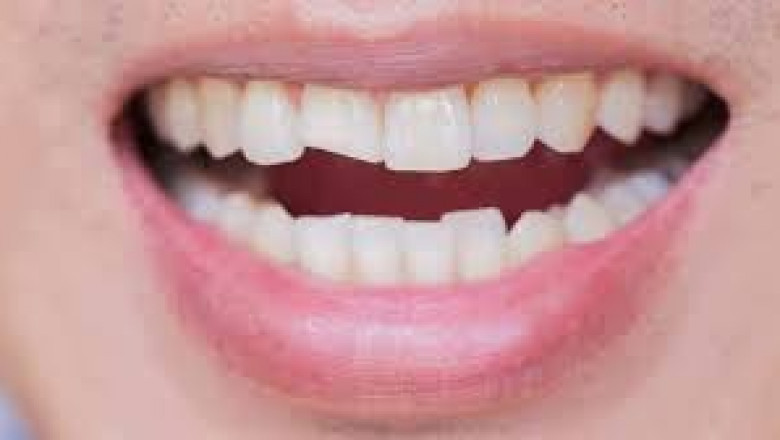 Top Questions to Ask Your Dentist During a Routine Checkup