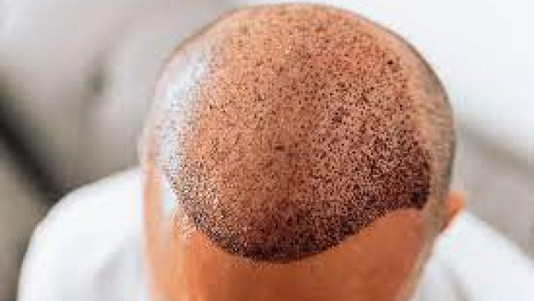 How to Choose Between FUE and FUT for Your Hair Transplant?