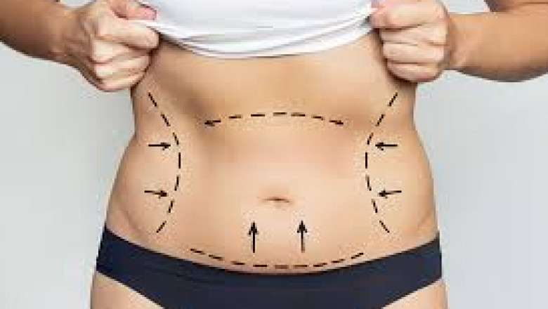 How Tummy Tuck in Dubai Can Transform Your Body After Weight Loss or Pregnancy
