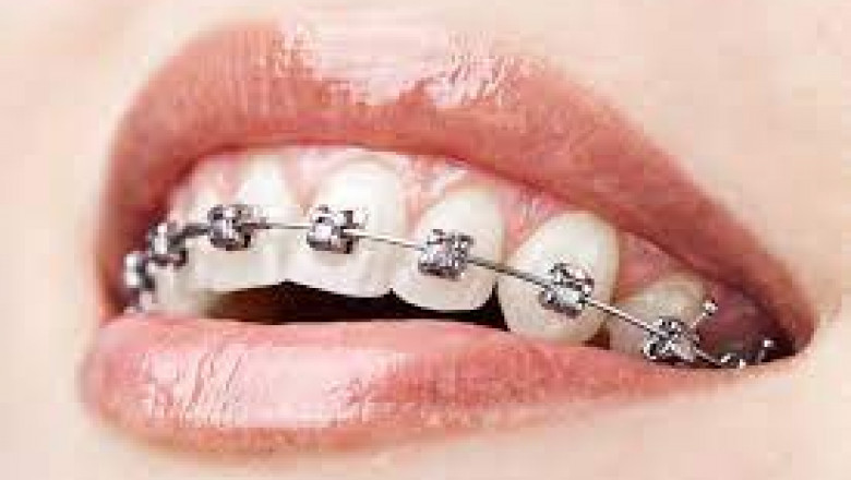 What Are Lingual Braces?