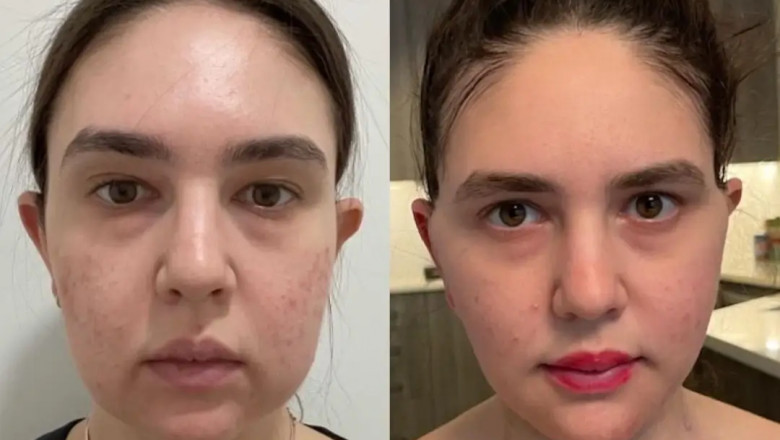 Achieve a Defined Look with Help from the Best Buccal fat removal Surgeons in dubai