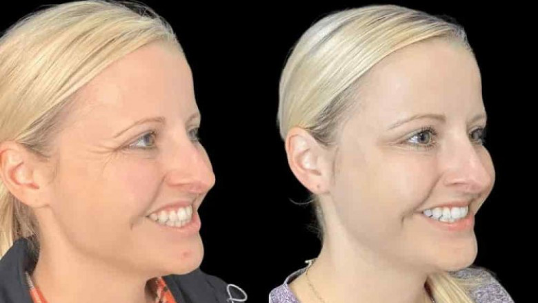 Achieving Natural Results with Botox in Dubai