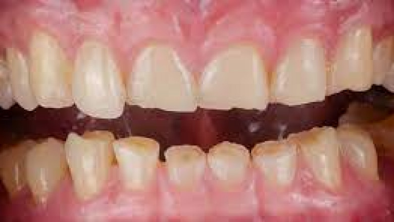 Are Dental Crowns Affected by Bruxism?