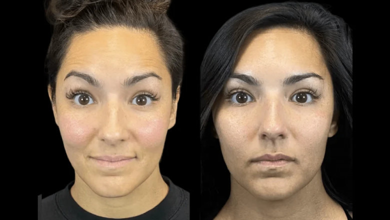Botox in Dubai and Skincare Routines: How to Combine for Best Results