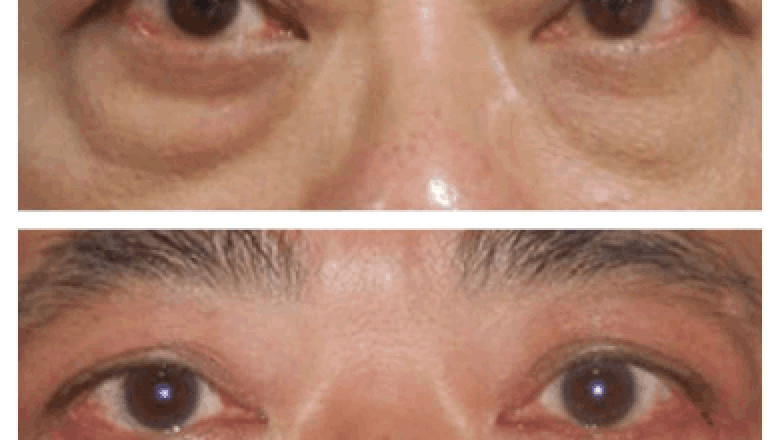 What Sets the Best Eye bag removal Surgeons in dubai Apart