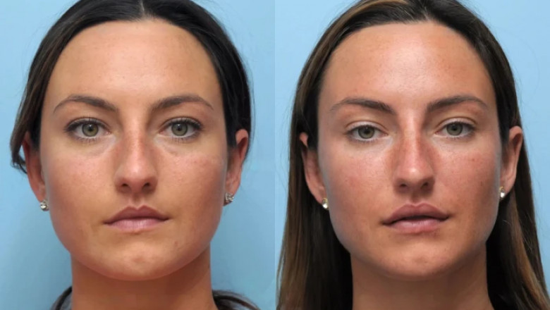 What to Expect from Your First Thread Lift in Dubai