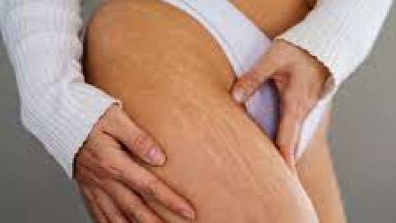 Does Diet Affect Stretch Mark Formation?