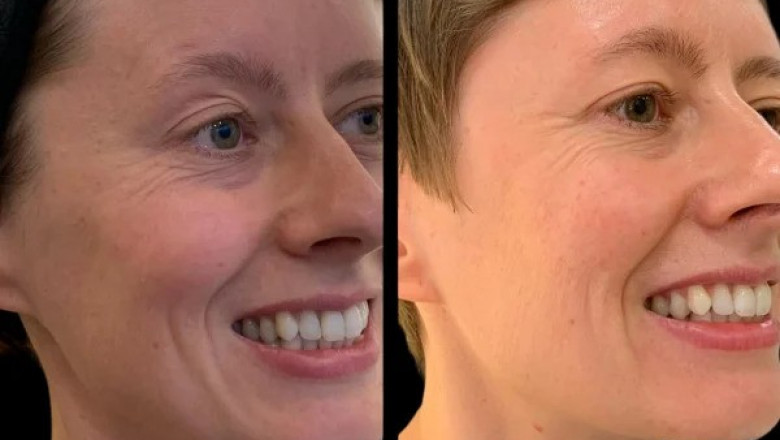 Aftercare Tips from the Best Plastic Surgeon in Dubai Following Profhilo Treatment
