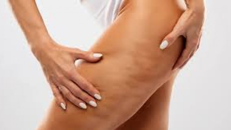 Are Injectable Treatments Available for Cellulite?