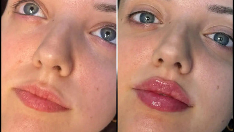 What Makes a Best Plastic Surgeon in Dubai for Fillers Stand Out?