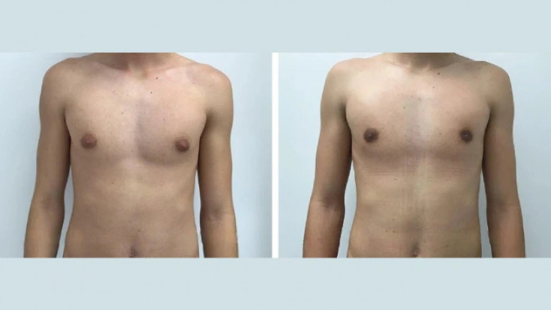Gynecomastia in Dubai: Causes, Symptoms, and Treatments