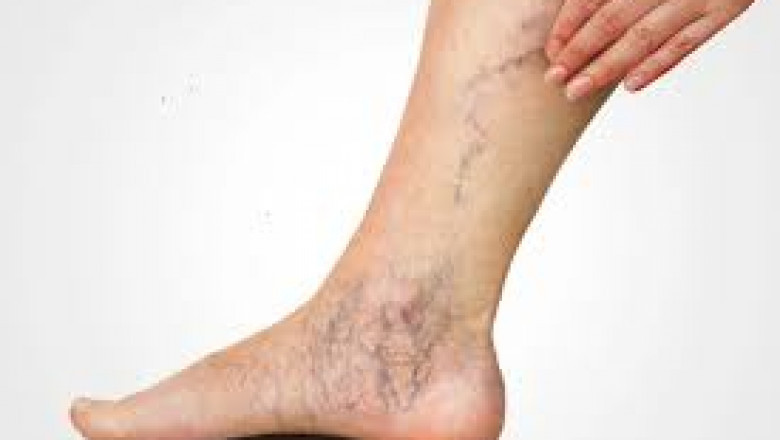 Can Varicose Veins Come Back After Treatment?