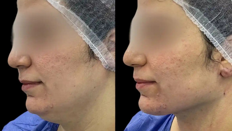 Chin Fillers Treatments in Dubai: The Secret to a Sculpted Chin