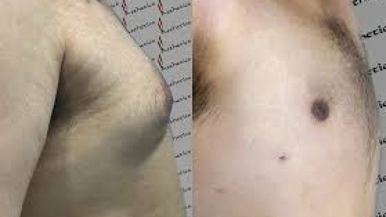 Choosing the Right Surgeon for Male Breast Reduction Islamabad