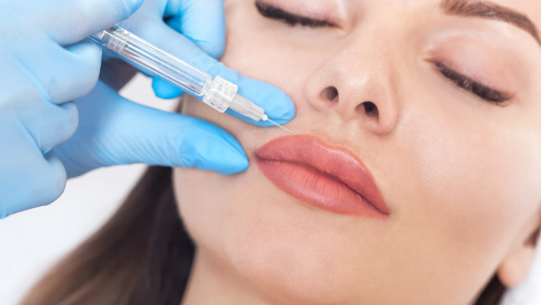 FAQs About Russian Lip Fillers Answered by Experts