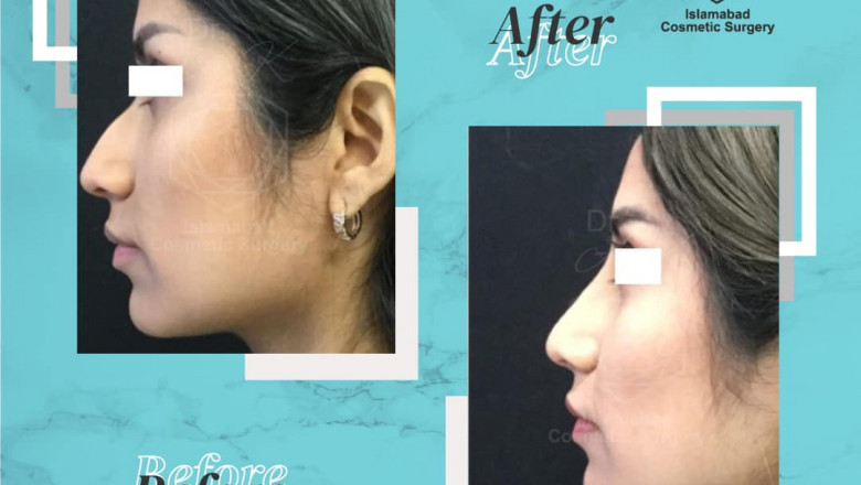 Success Stories of Cosmetic Surgery Islamabad: Real Transformations