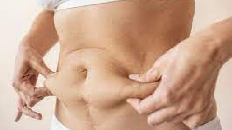 What Lifestyle Changes Are Needed After Bariatric Surgery?