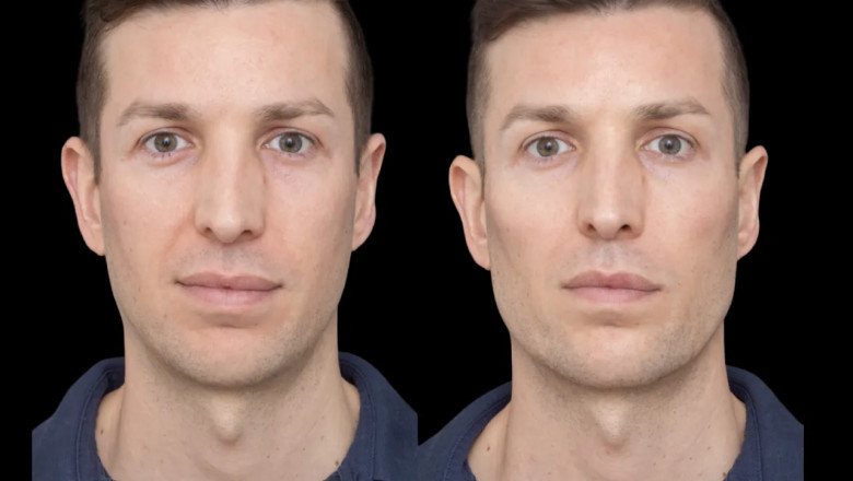 How Best Aesthetic Clinics in Dubai Personalize Your Cheek Fillers Treatment for a Perfect Look