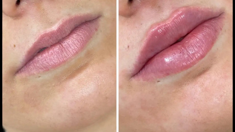 Russian Lip Fillers for Services the Best Aesthetic Clinics in Dubai