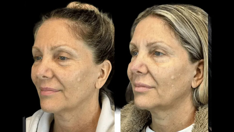 The Rise of Preventative Botox at the Best Aesthetic Clinics in dubai