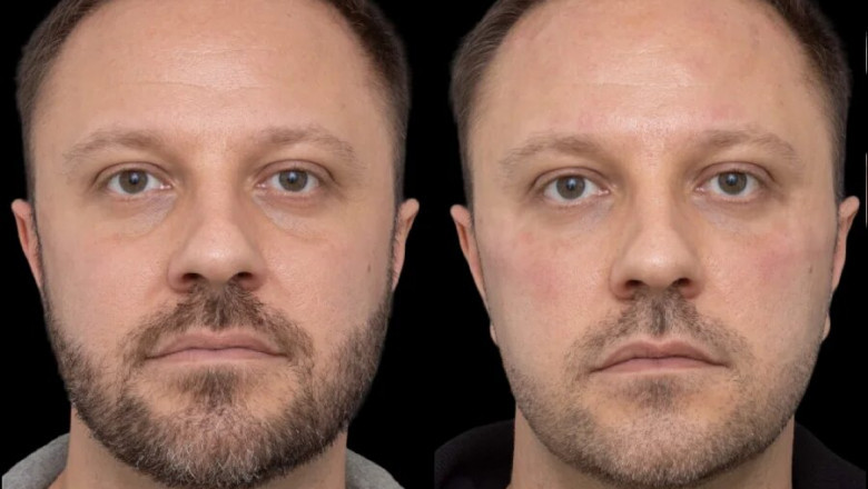 Under Eye Fillers Products Preferred by the Best Aesthetic Clinics in Dubai