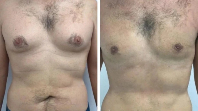 What Causes Gynecomastia in Dubai and How to Treat It