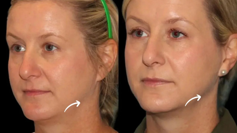 What to Wear After a Sculptra Fillers Treatment in Dubai’s Heat