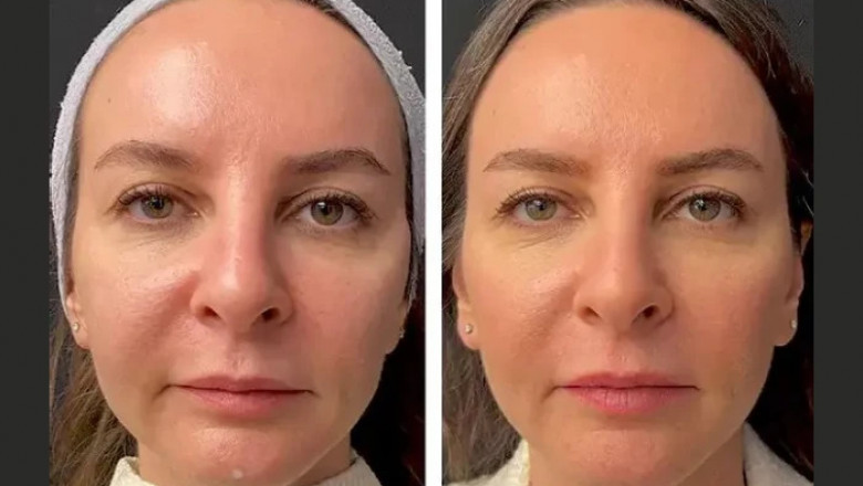 How the Best Plastic Surgeons in Dubai Use Mesotherapy for Skin Rejuvenation