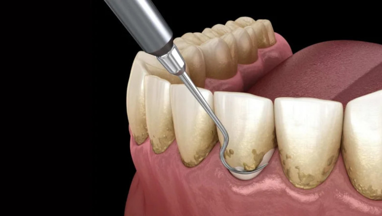 The Role of Restorative Dentistry in Preventing Future Dental Issues