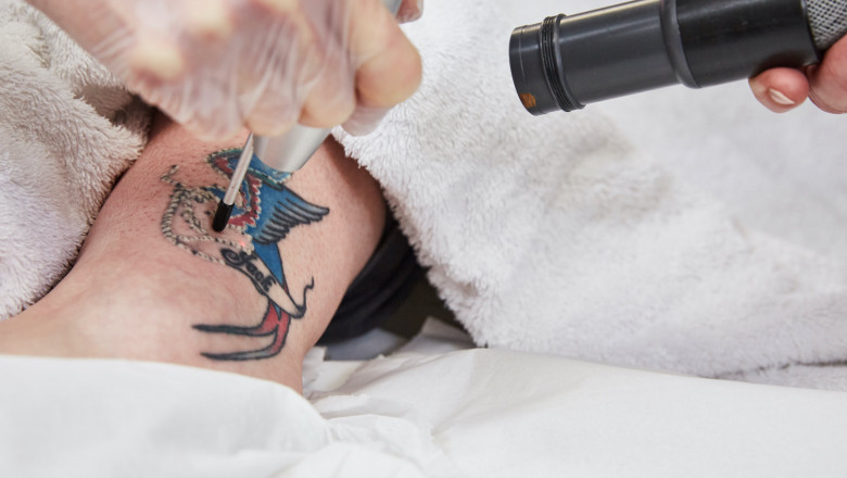 Can All Tattoos Be Removed? The Truth About Limitations
