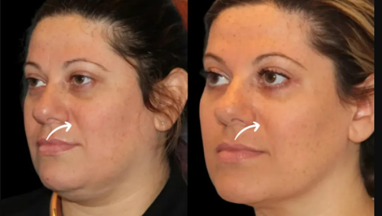 Best Doctors in Dubai Offer the Latest Innovations in Sculptra Fillers Application