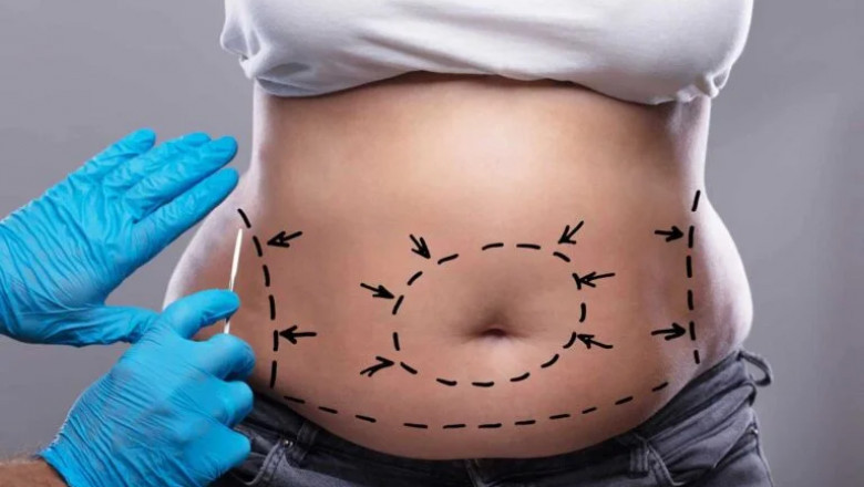 The Benefits of Choosing the Best Tummy Tuck Surgeon in Dubai for Your Body Contouring