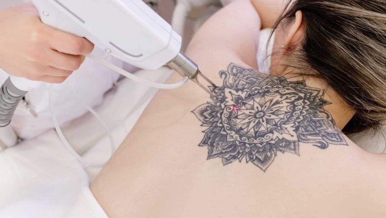 Aftercare Tips: How to Heal Faster After Laser Tattoo Removal
