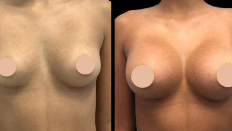 Best Time to Get Breast Augmentation Surgery in Dubai
