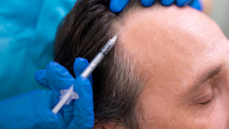 PRP for Thinning Hair: What Kind of Results Can You Expect?