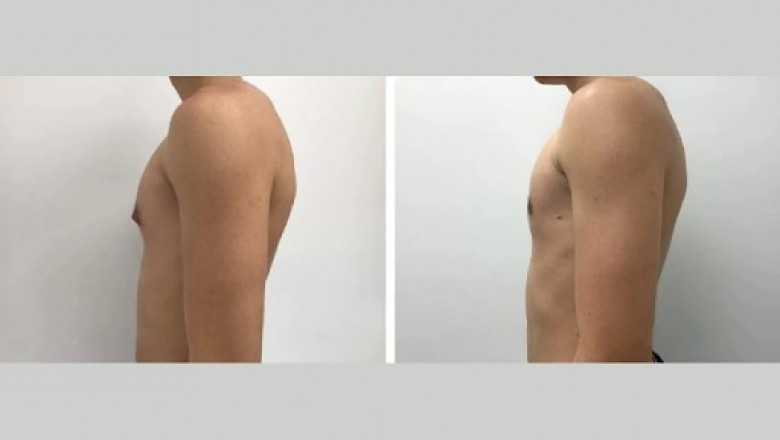 What Sets the Best Gynecomastia Surgeon in Dubai Apart?